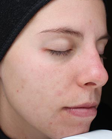 Vi Peels Before & After