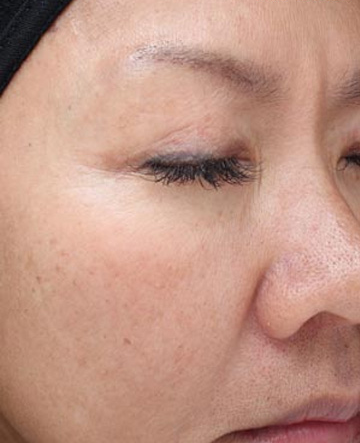 Vi Peels Before & After