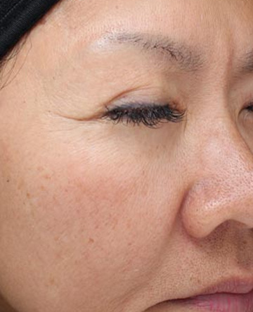 Vi Peels Before & After