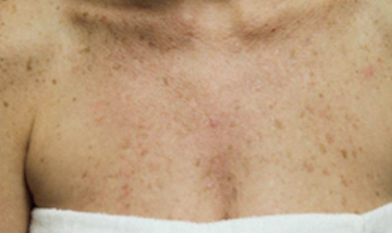 Vi Peels Before & After