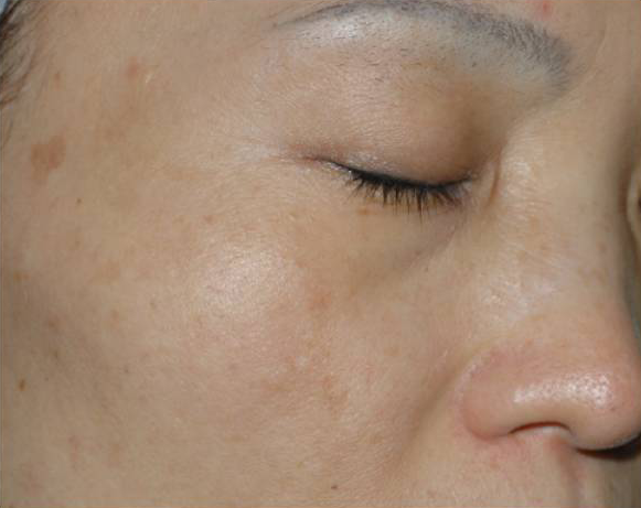 Vi Peels Before & After