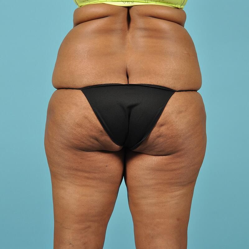 Body Lift Before & After