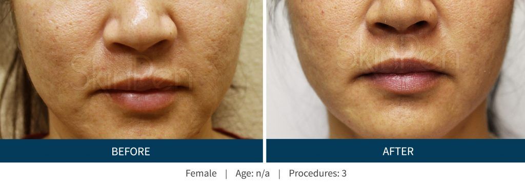 Dermaplaning Before & After