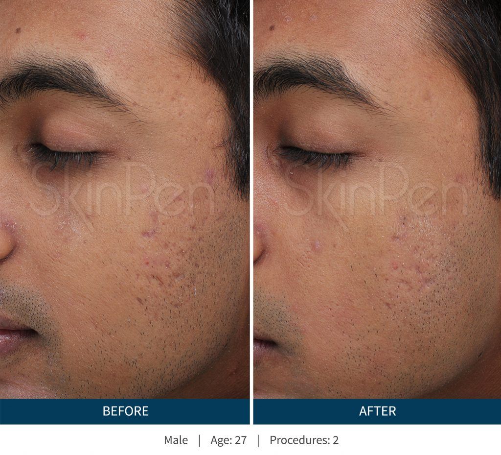 Dermaplaning Before & After