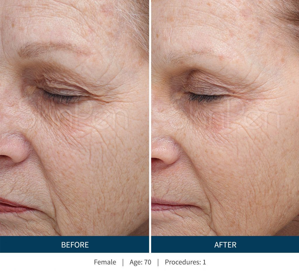 Dermaplaning Before & After