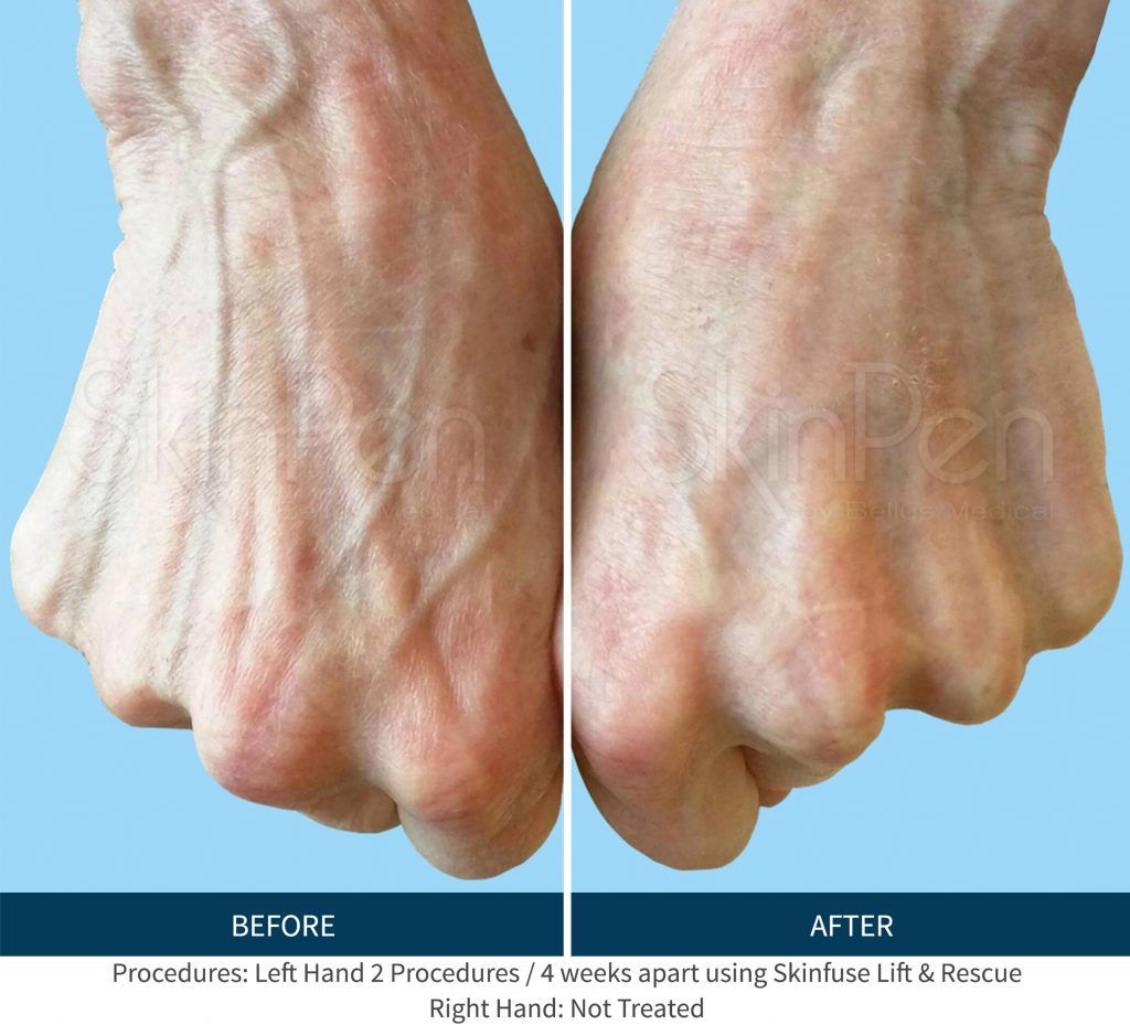 Dermaplaning Before & After