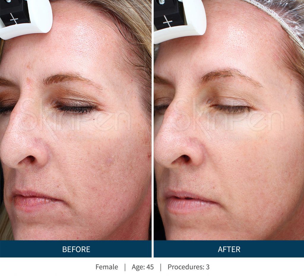 Dermaplaning Before & After