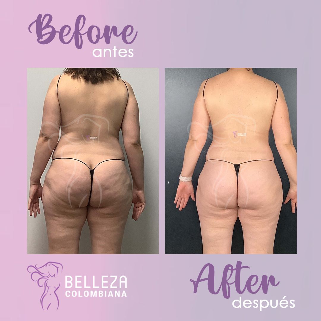 Facelift Before & After