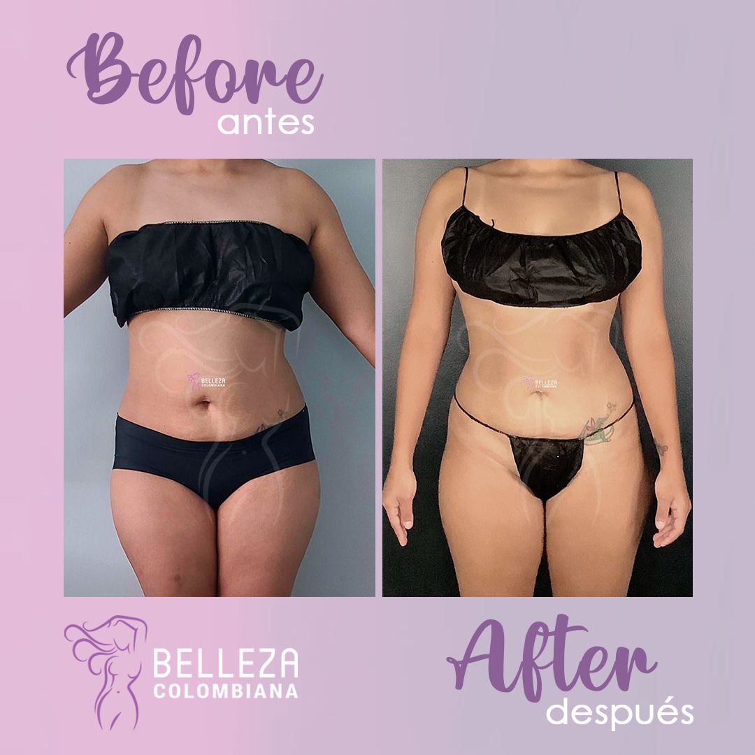 Facelift Before & After