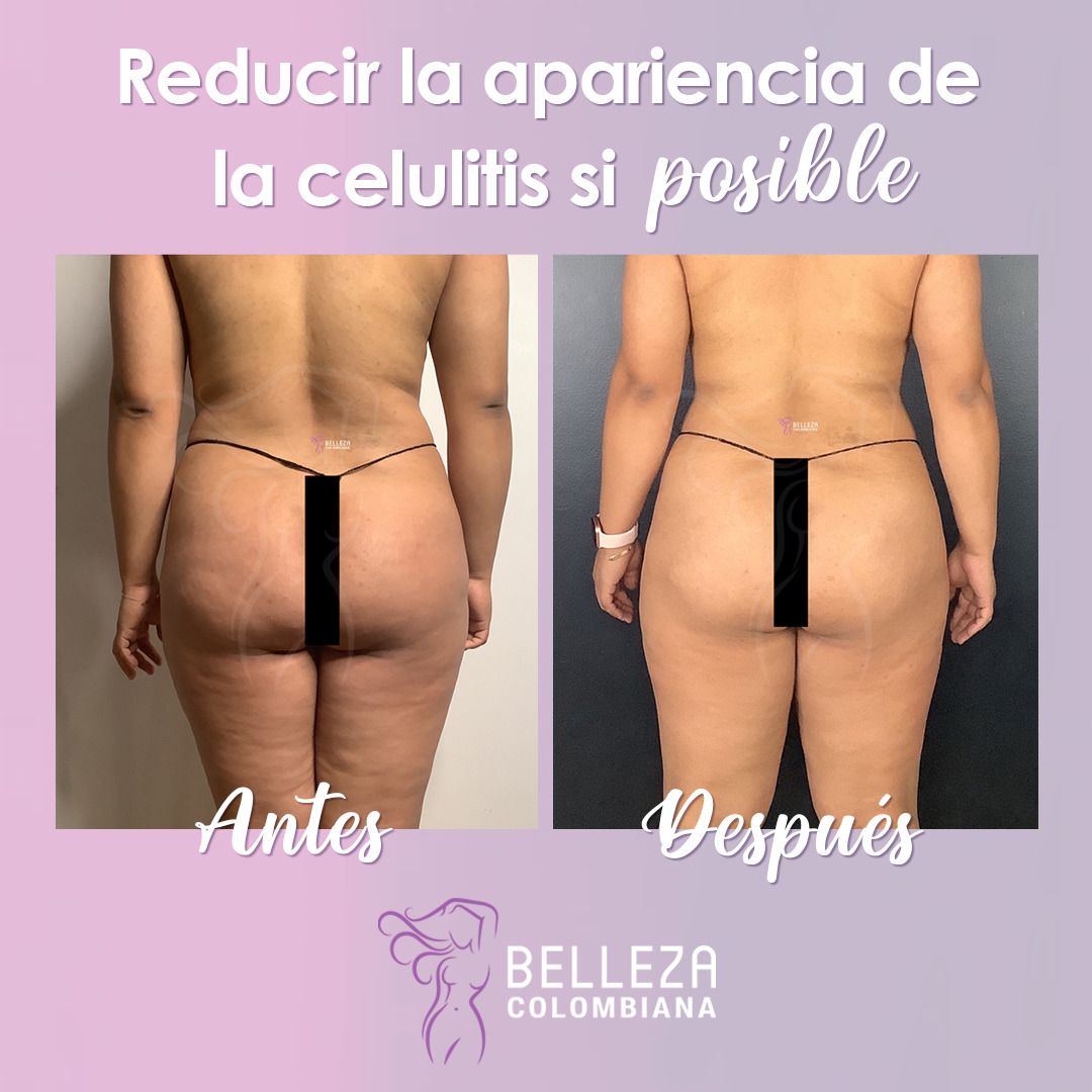 Facelift Before & After