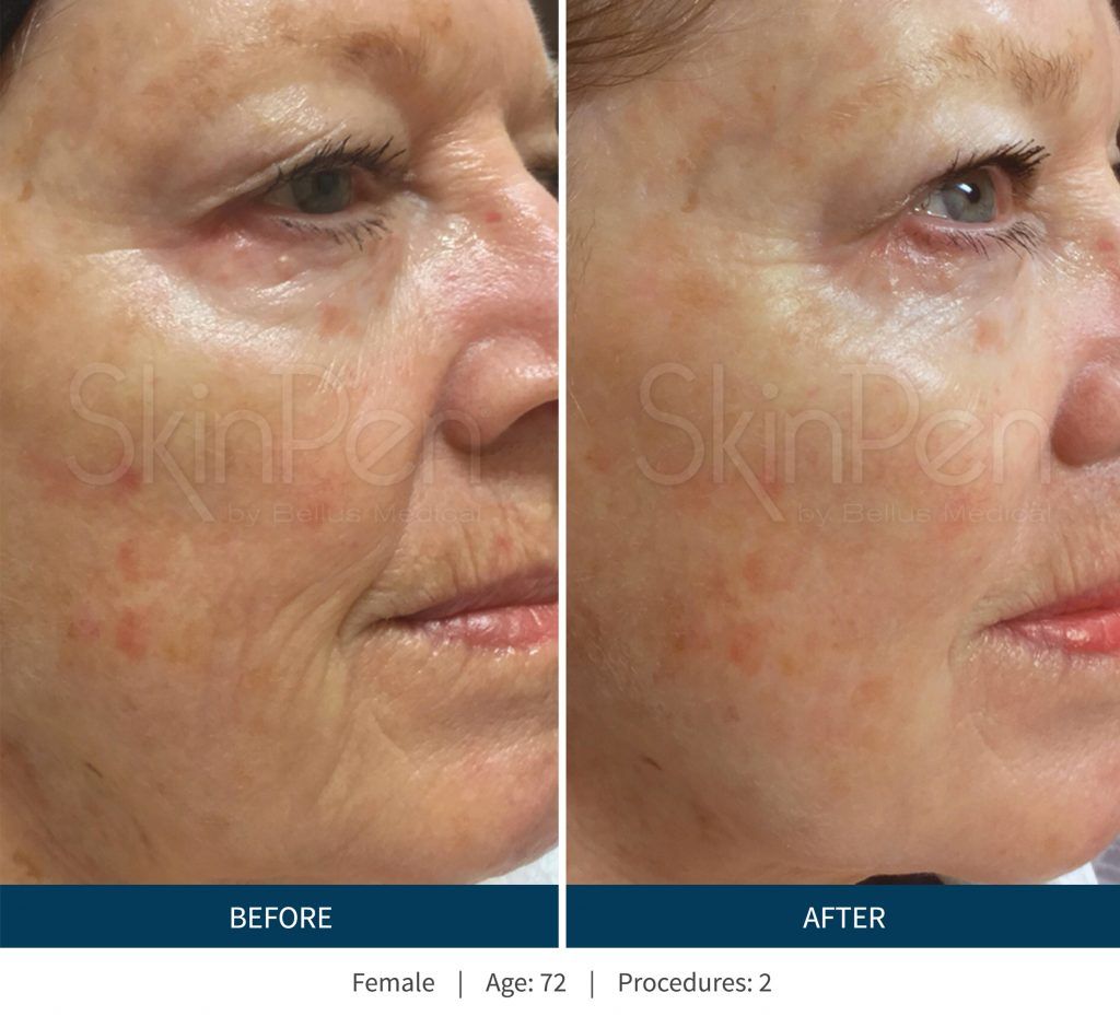 Microneedling Before & After