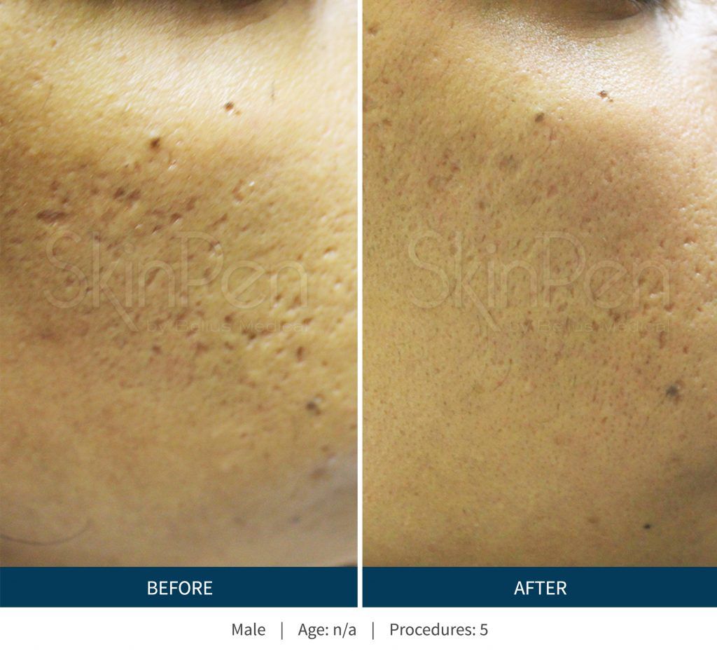 Microneedling Before & After