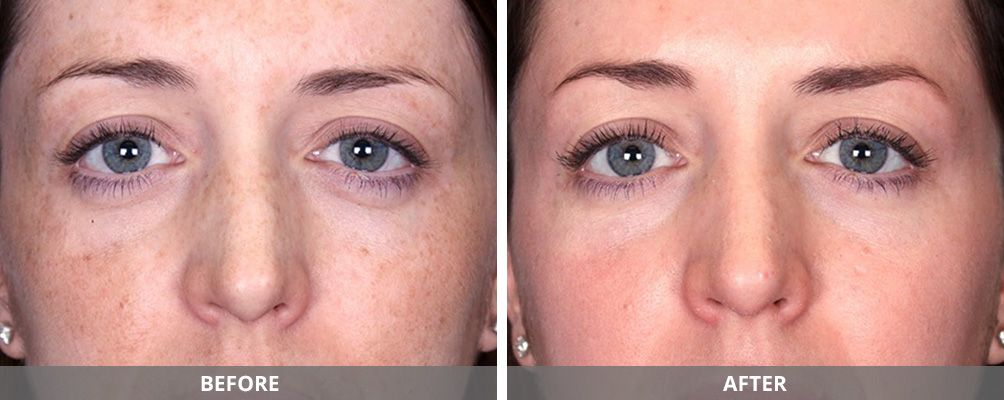 Chemical Peels Before & After