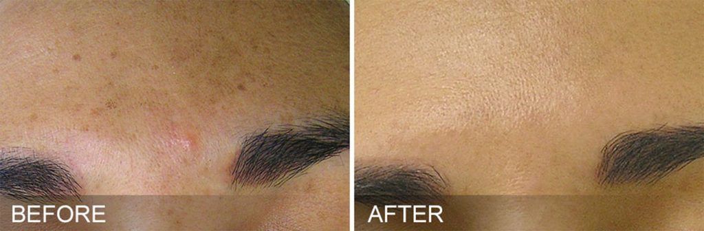 Hydrafacial Before & After